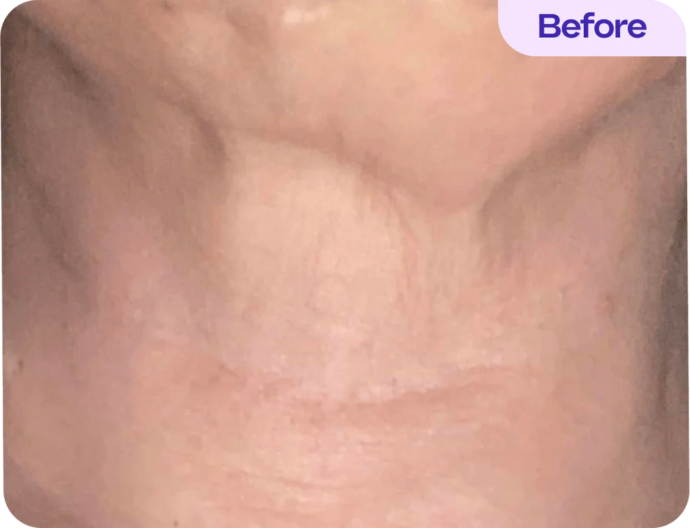 Before treatment