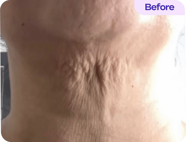 Before treatment